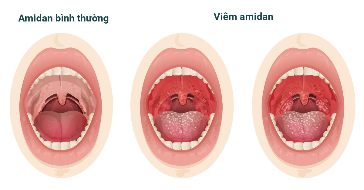 Bệnh viêm amidan