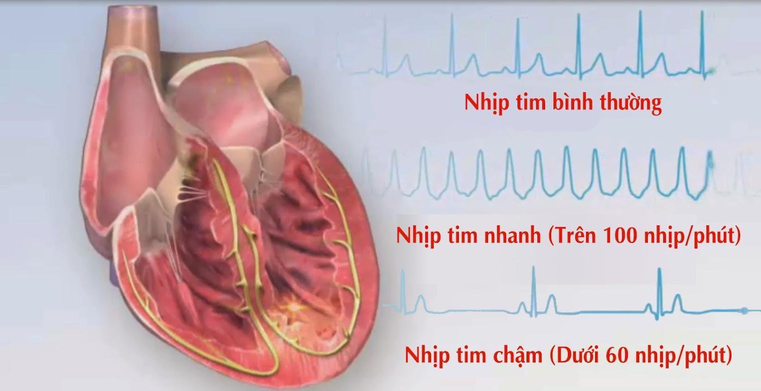 Các bài thuốc Đông y điều trị rối loạn nhịp tim