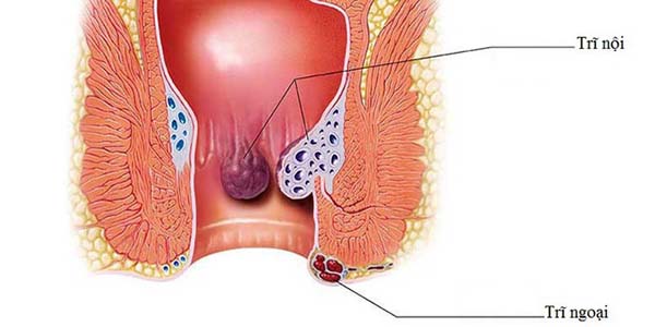 Cách nhận biết người cao tuổi đang mắc phải căn bệnh trĩ