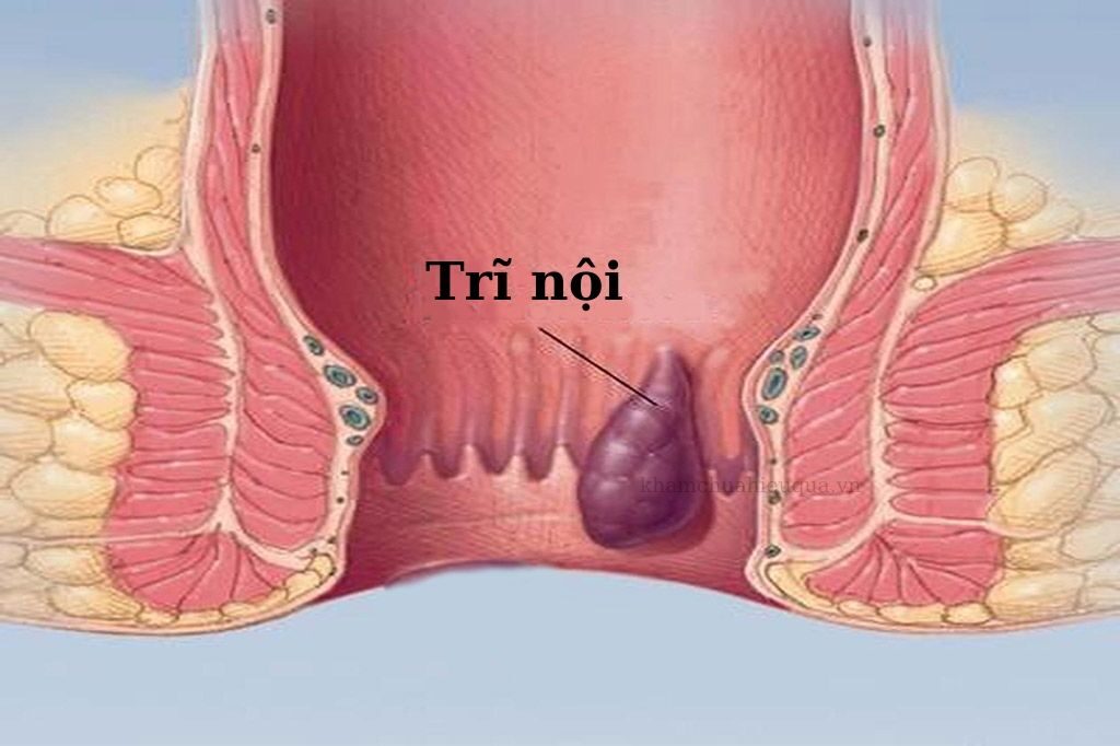 Do mắc bệnh trĩ