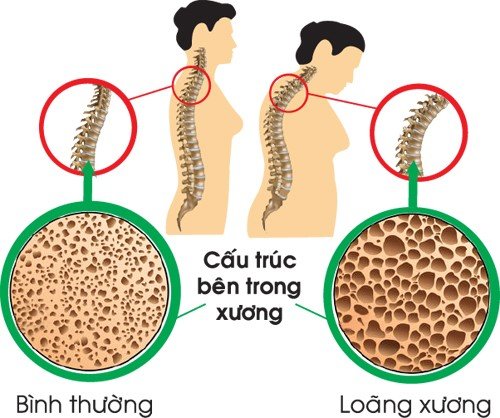 Hiểu biết về bệnh loãng xương