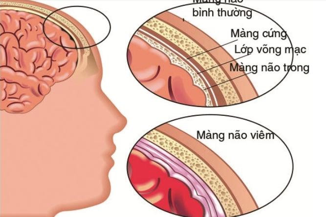 Nguyên nhân khiến trẻ bị viêm màng não