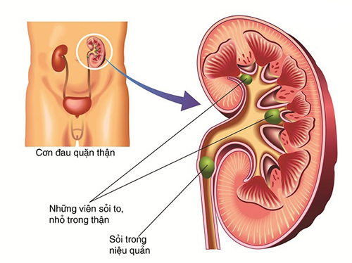 Nguyên nhân nội sinh gây nhiễm trùng đường tiểu ở người cao tuổi như sỏi đường tiết niệu