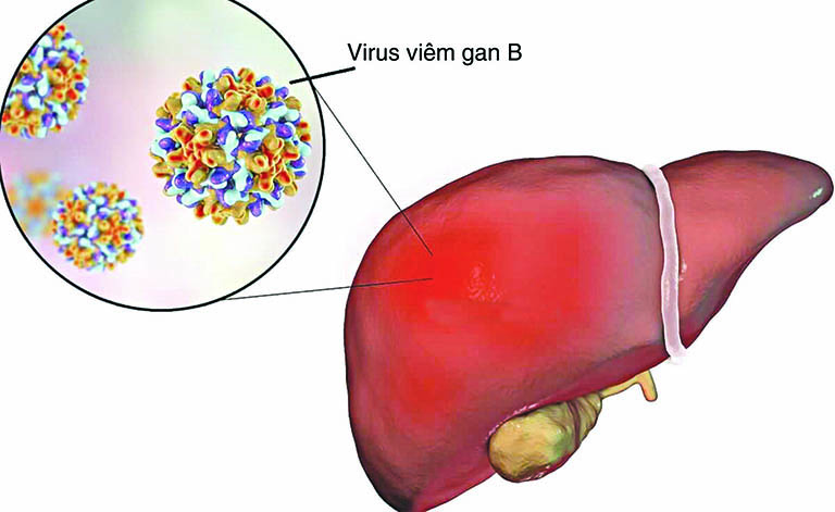 Những điều cần biết về căn bệnh viêm gan B ở trẻ em