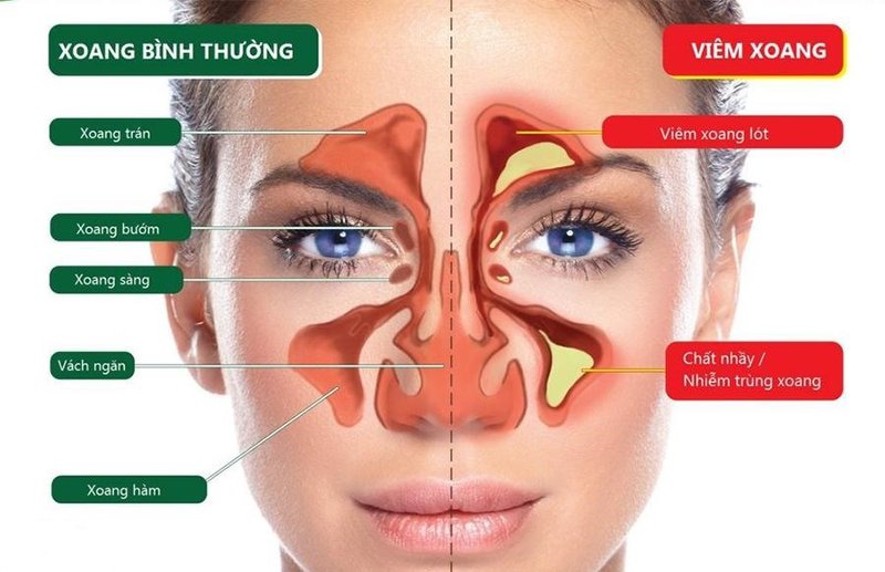 Tìm hiểu về bệnh viêm mũi xoang ở người cao tuổi