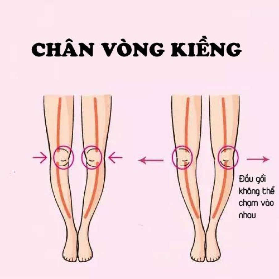 Các nguyên nhân khiến trẻ bị chân vòng kiềng mà mẹ nên biết